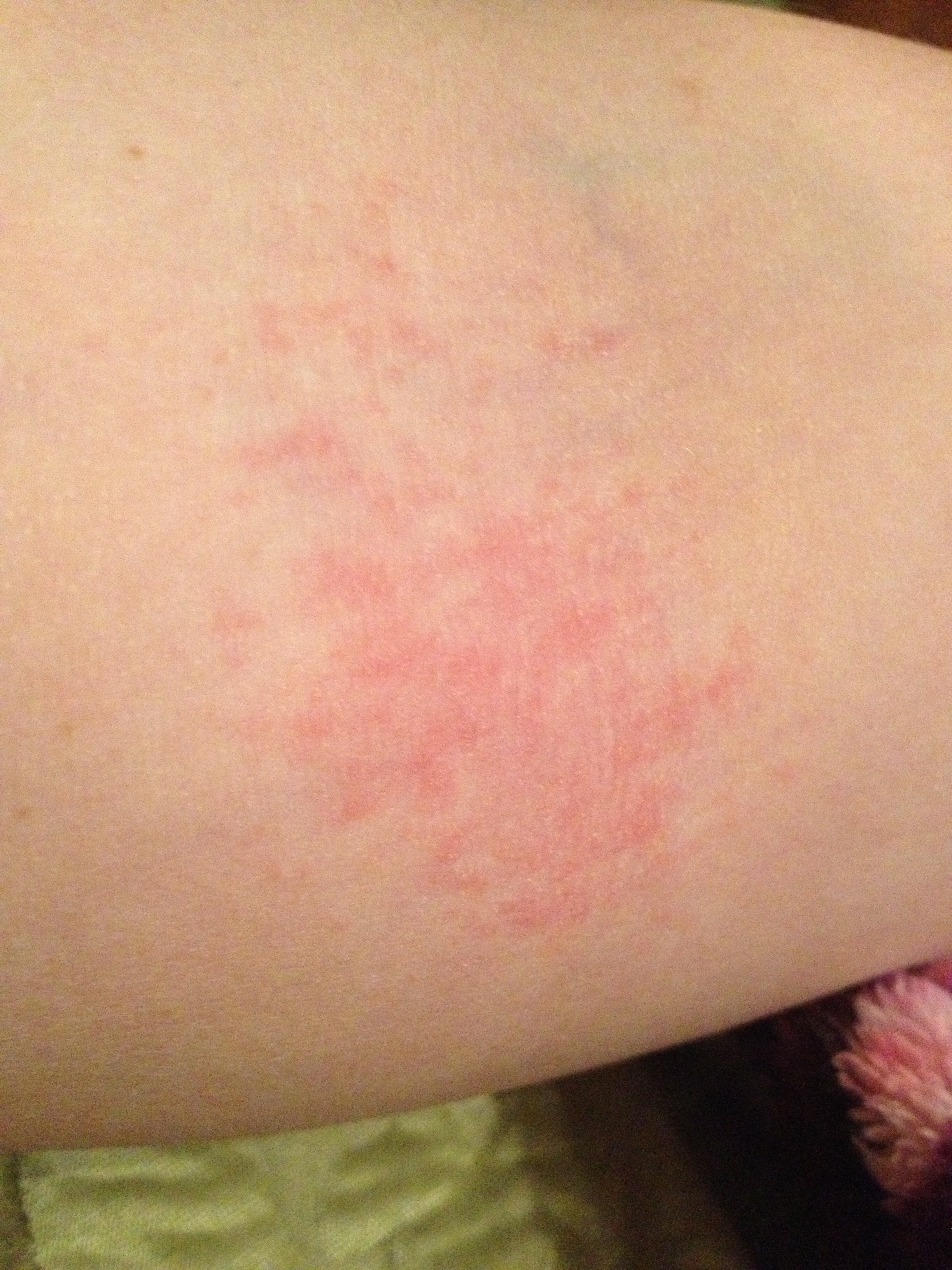rash on inside of elbow #11